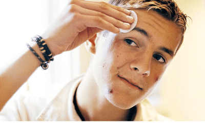 Fractional CO2 Laser: A Non-Invasive Treatment For Acute Teenage Acne