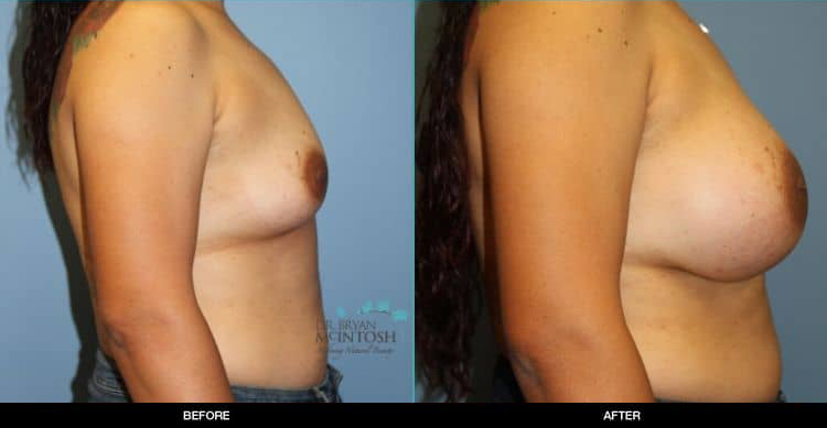 Breast-Augmentation-2