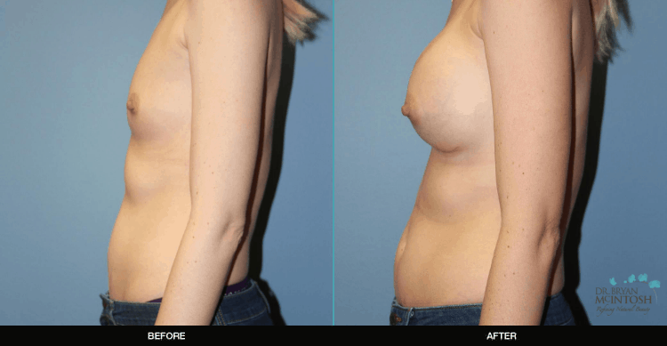 Breast-Augmentation-2