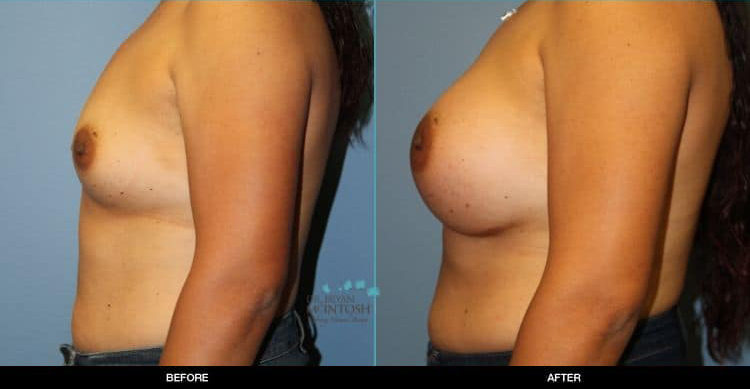 Breast-Augmentation-3