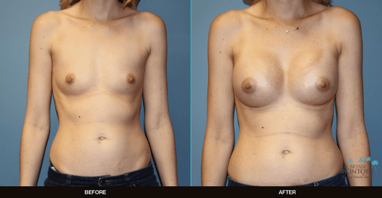 Breast-Augmentation