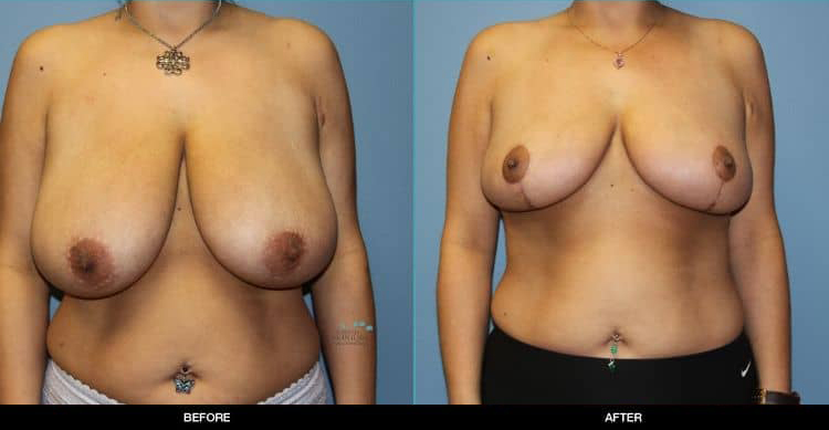 Breast-Reduction-1