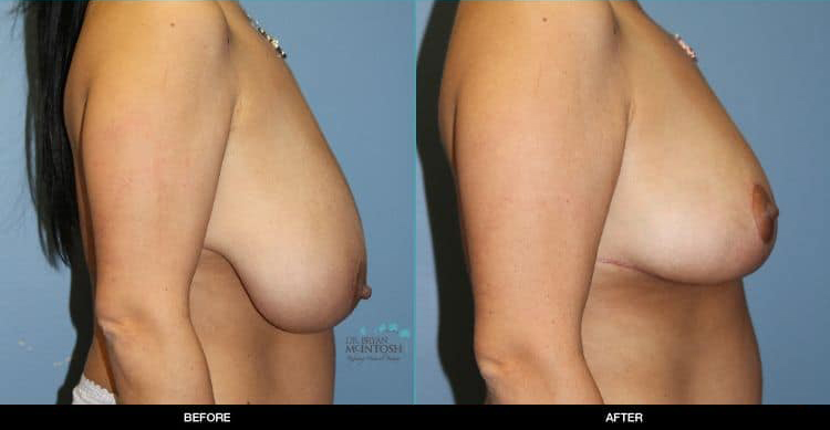 Breast-Reduction-2