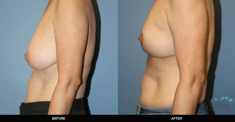 Breast-Reduction-3