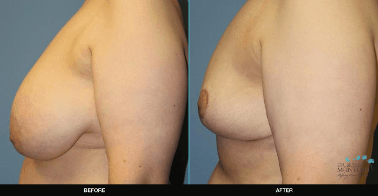 Breast-Reduction-4