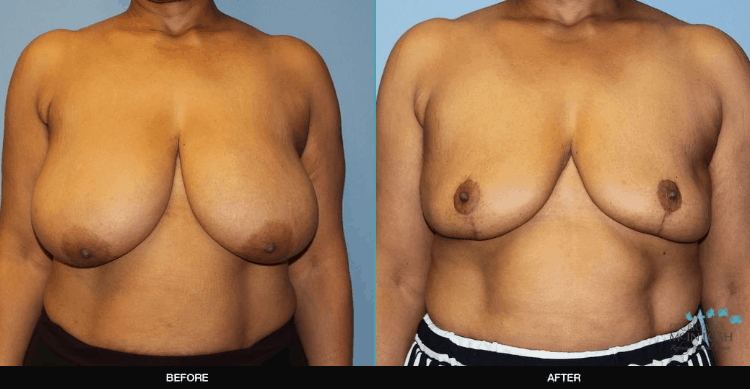 Breast-Reduction-6