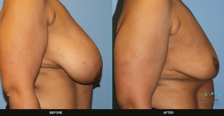Breast-Reduction-7