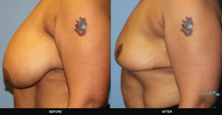 Breast-Reduction-8