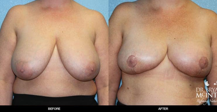Breast-Reduction-BA-1-1-1