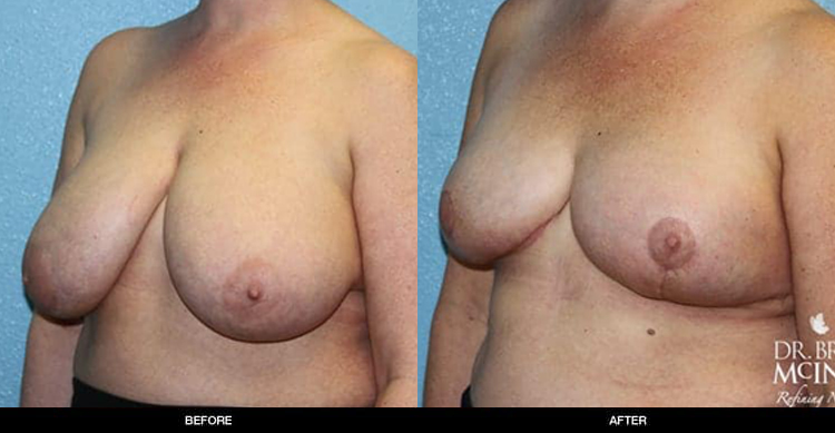 Breast-Reduction-BA-1-2-1
