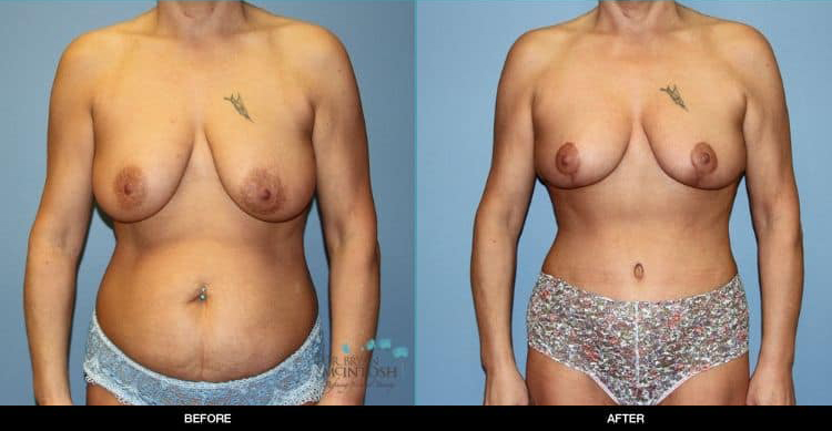 Breast-Reduction-Liposuction-Abdominoplasty-6-13-19a