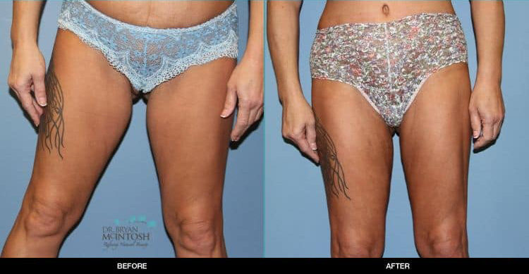 Breast-Reduction-Liposuction-Abdominoplasty-6-13-19b