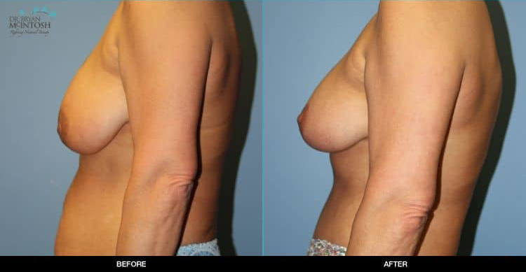 Breast-Reduction-Liposuction-Abdominoplasty-6-13-19c