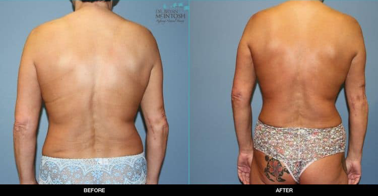 Breast-Reduction-Liposuction-Abdominoplasty-6-13-19d