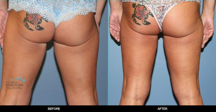 Breast-Reduction-Liposuction-Abdominoplasty-6-13-19e