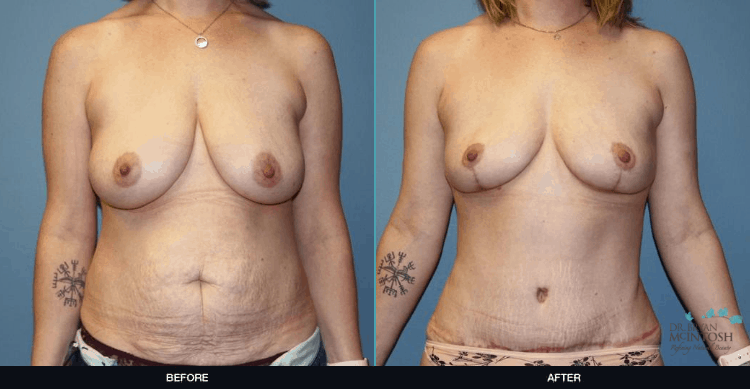 Breast-Reduction-Tuck-2