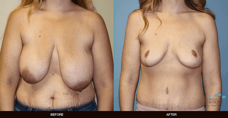 Breast-Reduction-Tuck