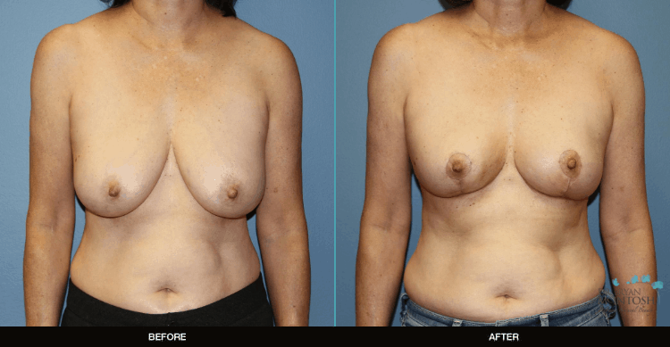 Breast-Reduction