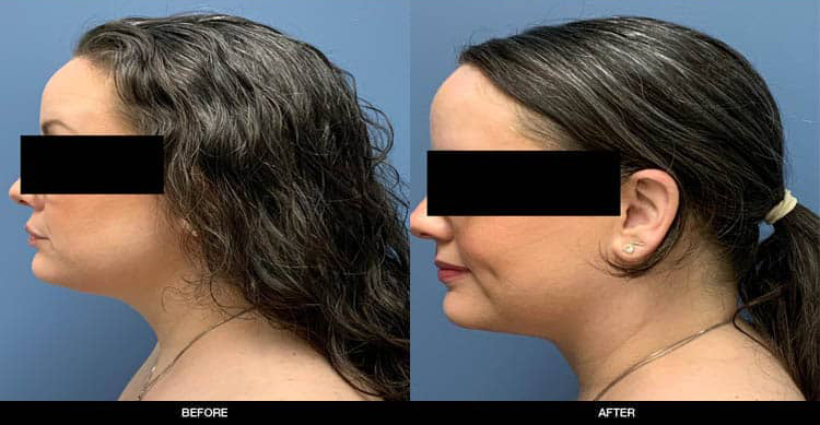 Chin-Liposuction-Full