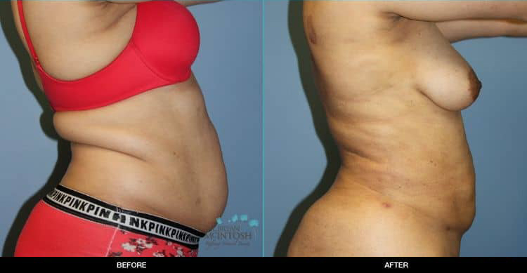 Liposuction-062419a