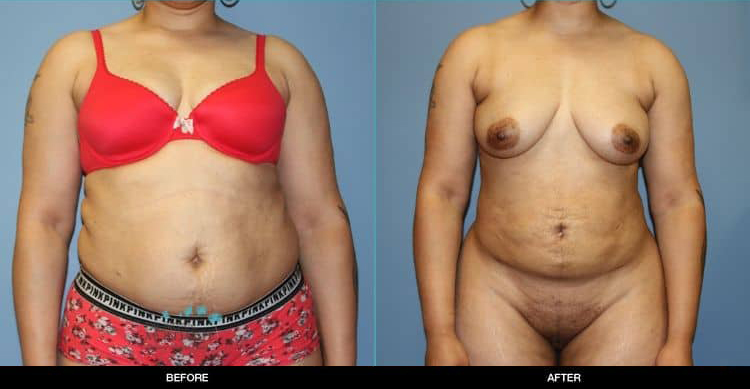 Liposuction-062419b