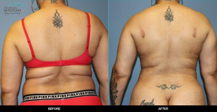 Liposuction-062419c