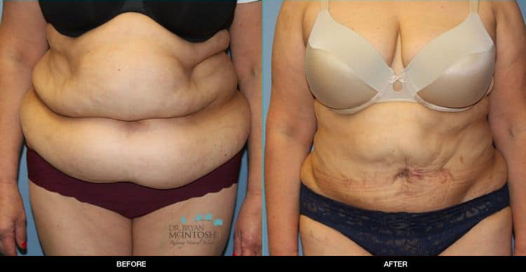Liposuction-Abdominoplasty-061119a