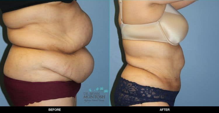 Liposuction-Abdominoplasty-061119b