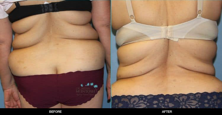 Liposuction-Abdominoplasty-061119c