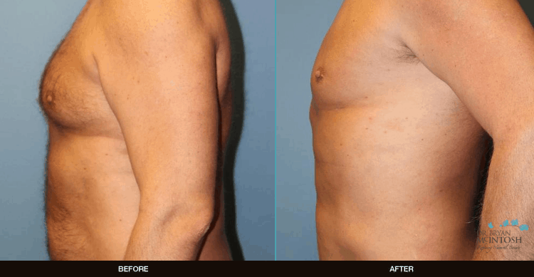 Male-Breast-Reduction-Liposuction-2