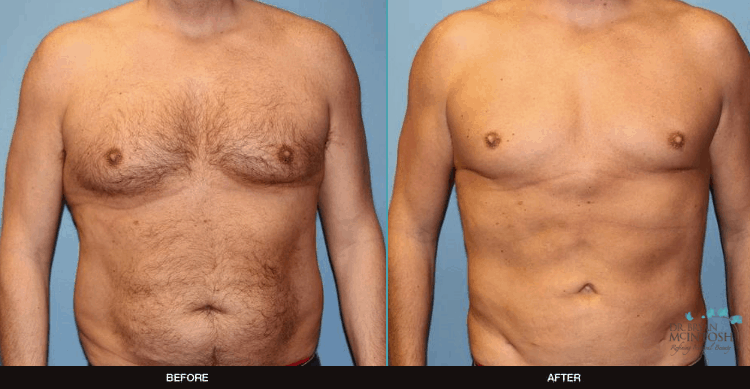 Male-Breast-Reduction-Liposuction-3