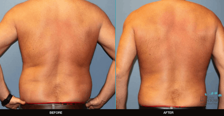 Male-Breast-Reduction-Liposuction