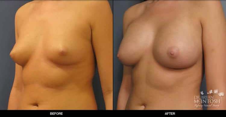 breast-augmentation-1-2