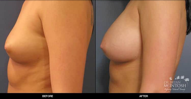 breast-augmentation-1-3