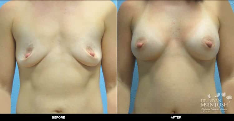 breast-augmentation-2-1