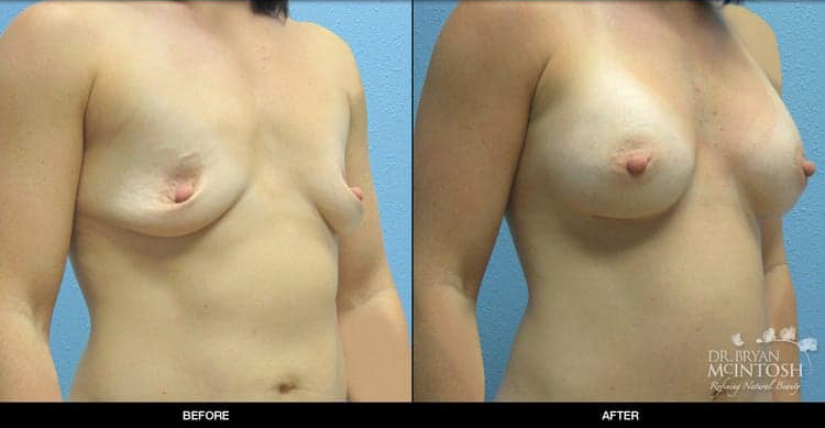 breast-augmentation-2-2