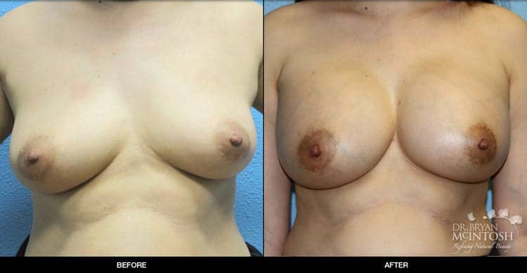 breast-augmentation-3-1