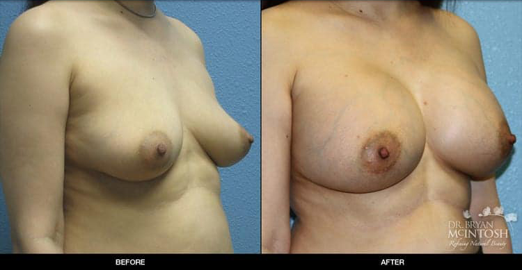 breast-augmentation-3-2