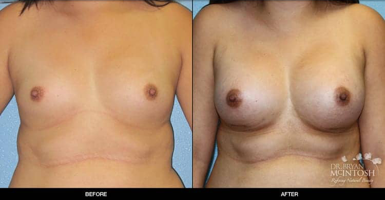 breast-augmentation-4-1