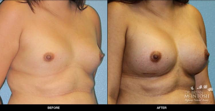 breast-augmentation-4-2