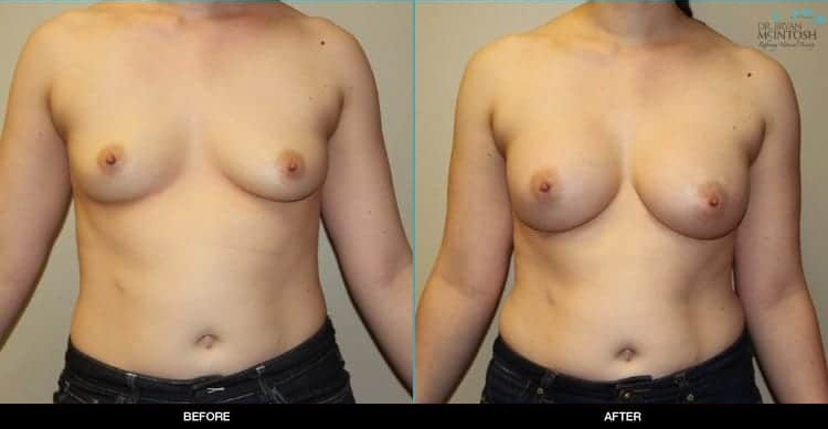 breast-augmentation-5a