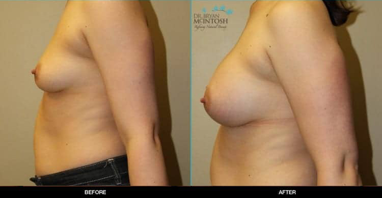 breast-augmentation-5b