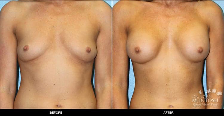breast-augmentation-7-1