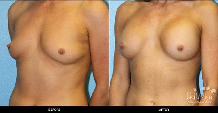 breast-augmentation-7-2
