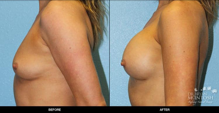 breast-augmentation-7-3