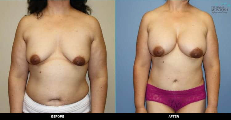 breast-augmentation-abdominoplasty-1a