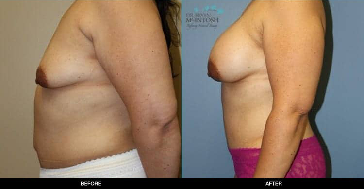 breast-augmentation-abdominoplasty-1b