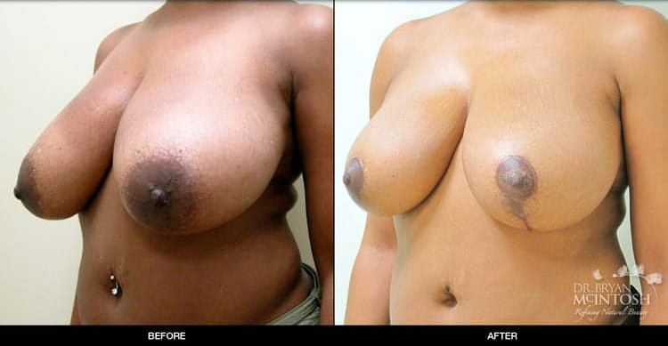 breast-reduction-1-2