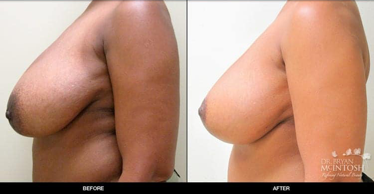 breast-reduction-1-3