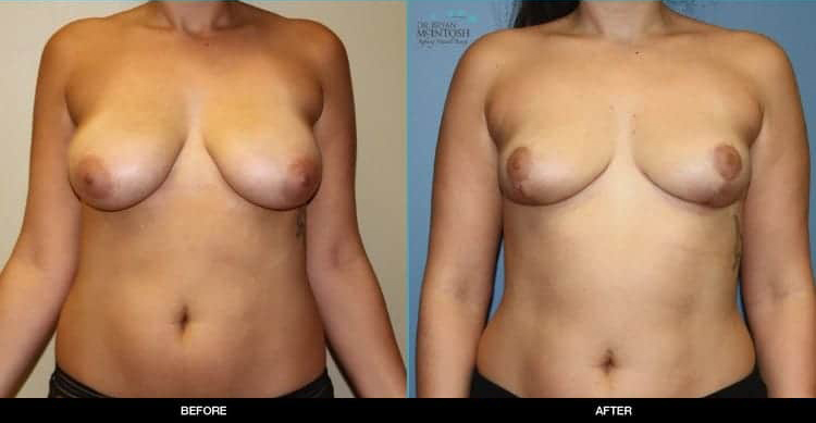 breast-reduction-1a